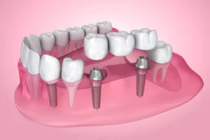 implant dentist