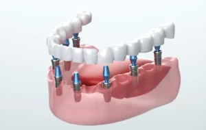 implant dentist