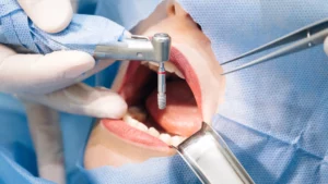 implant dentist