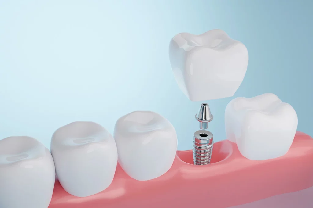 Implant Dentist