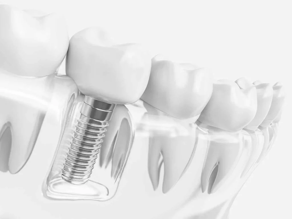 dental implants