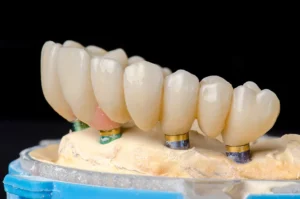 Implant Dentist