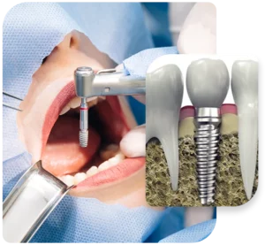 implant dentist