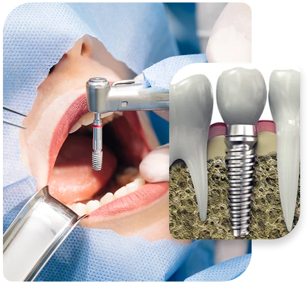 implant dentist