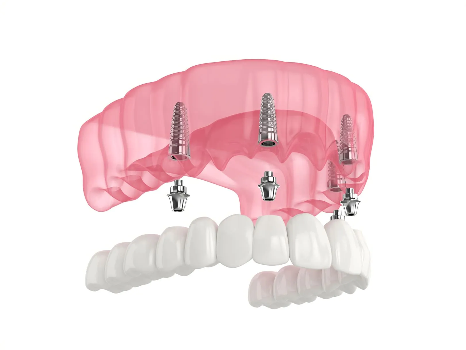 All on x dental implants