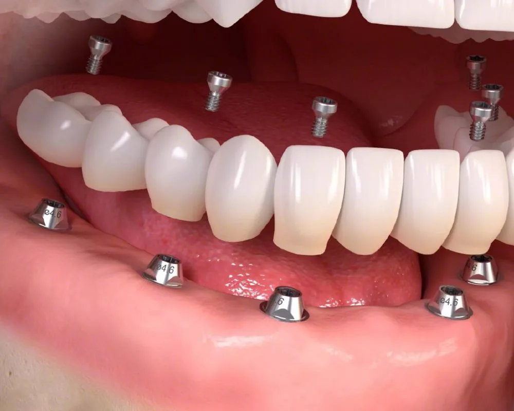 All on 6 Dental Implants