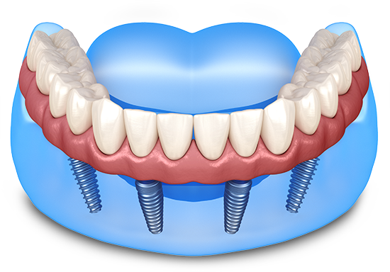 Implant Dentist