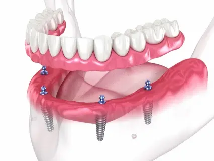 Implant Dentist