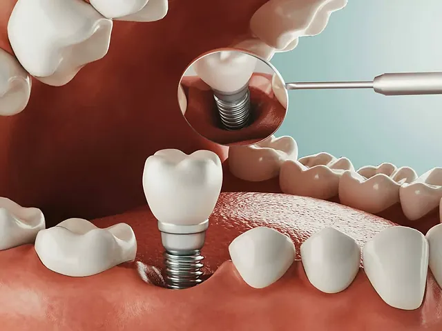 Implant Dentist