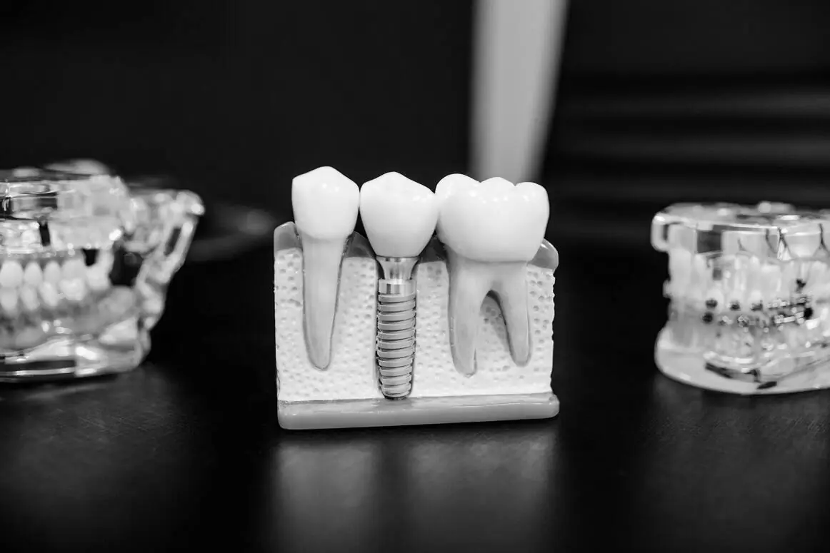 Dental Implant