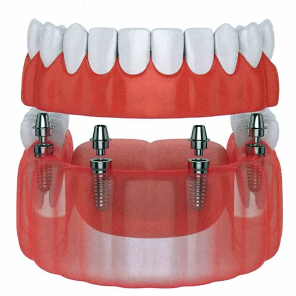 All on 4 dental implants