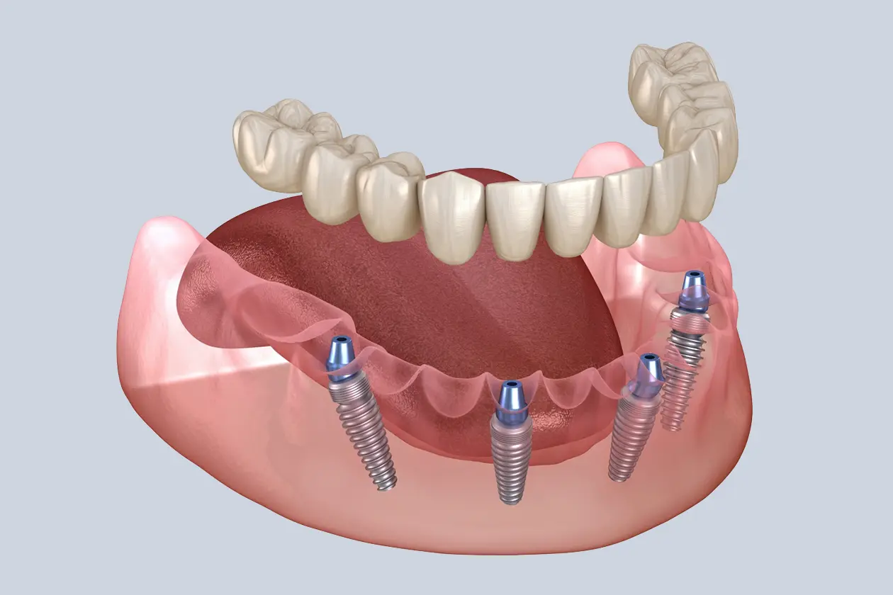 All on 4 dental implants