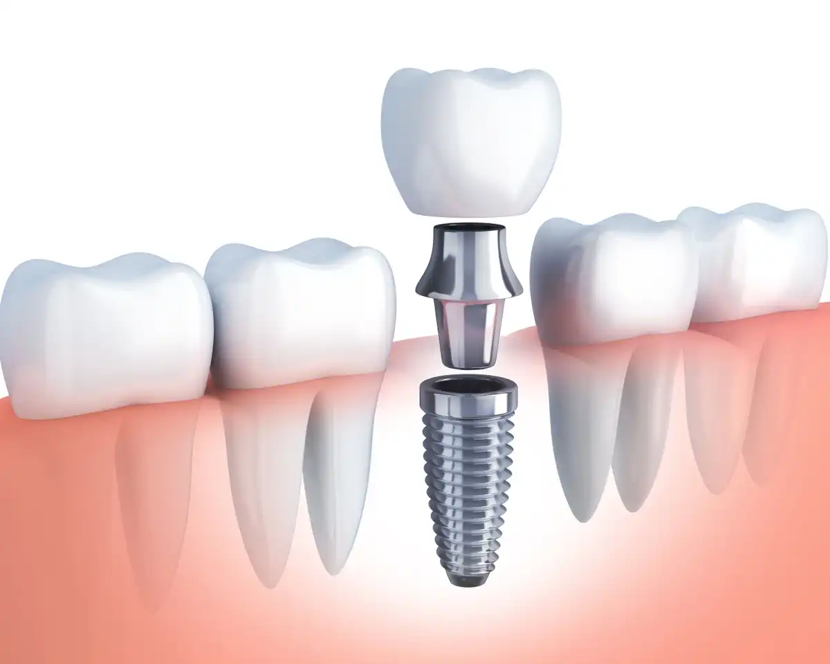 Implant Dentist