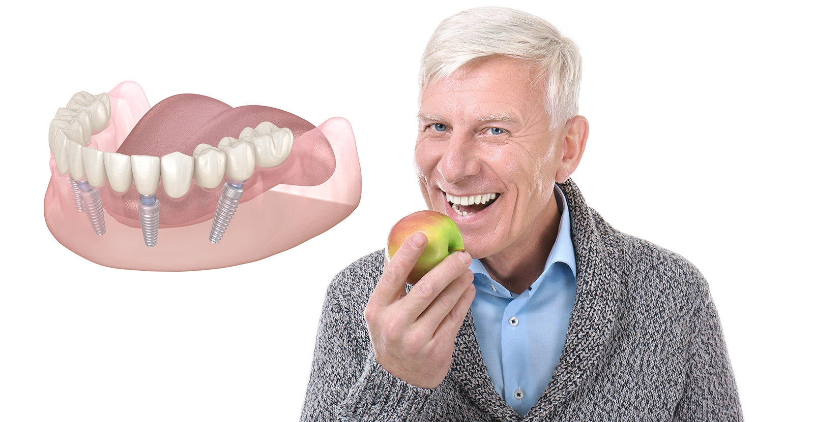 All on X Dental Implants