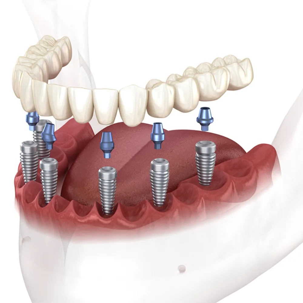 All on 6 dental implants