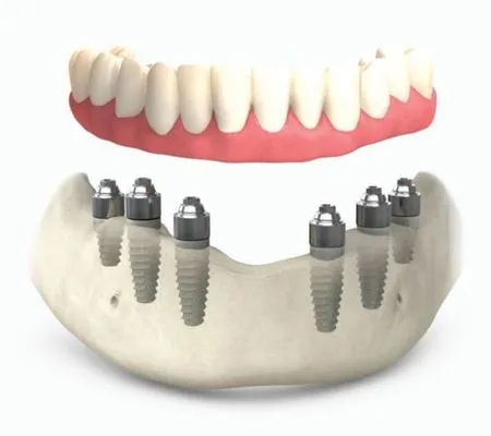 All on 6 dental implants