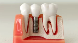 Implant Dentist