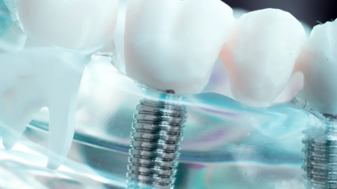 Implant Dentist