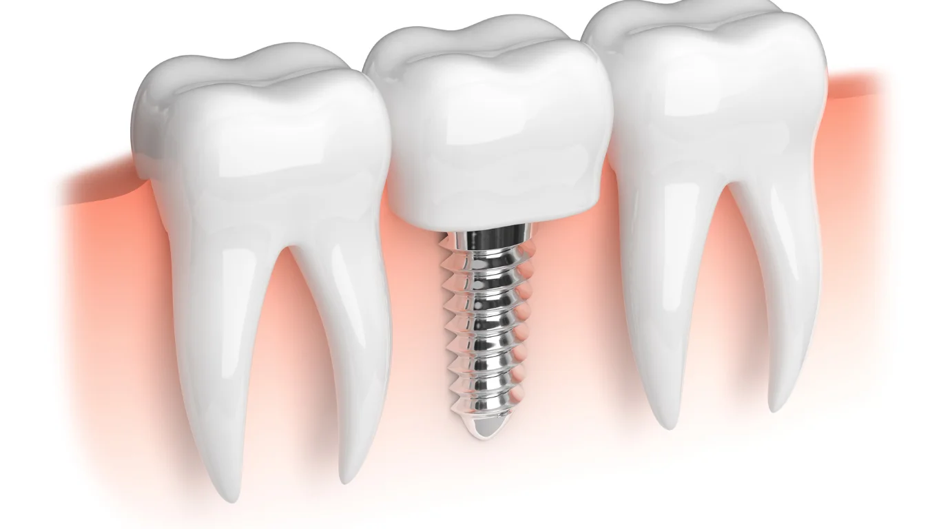 Dental Implant