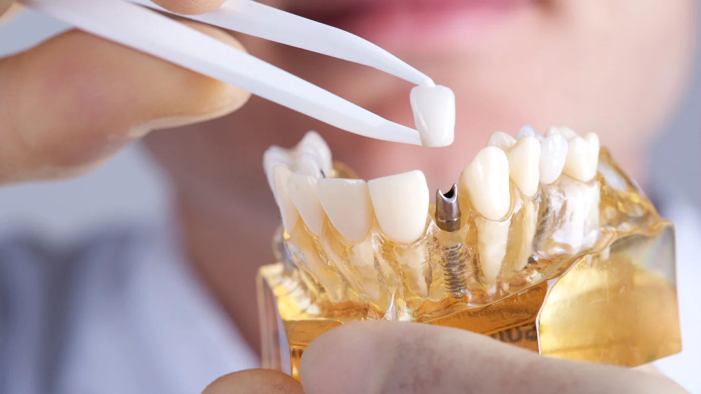 Implant Dentist