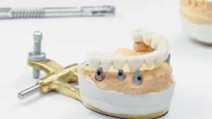 All on X Dental Implants