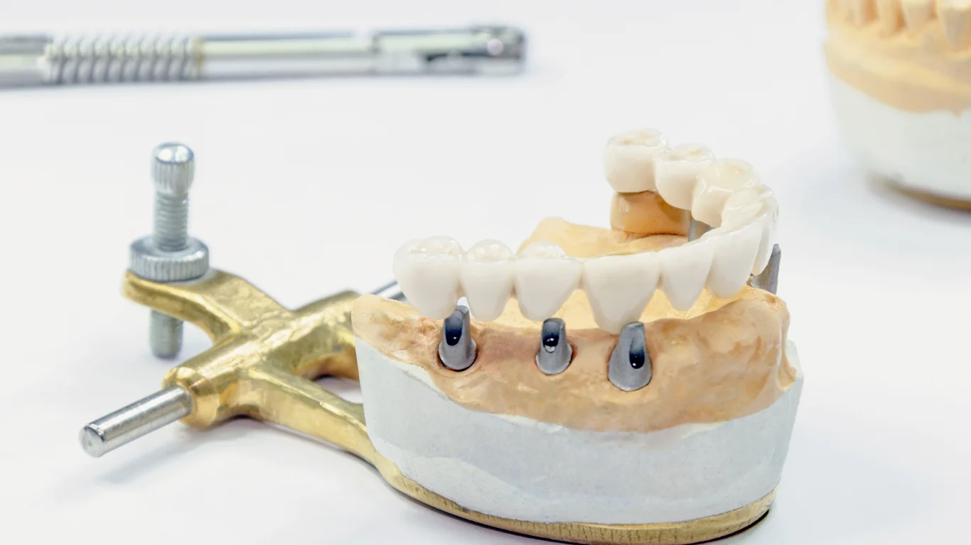 All on X Dental Implants