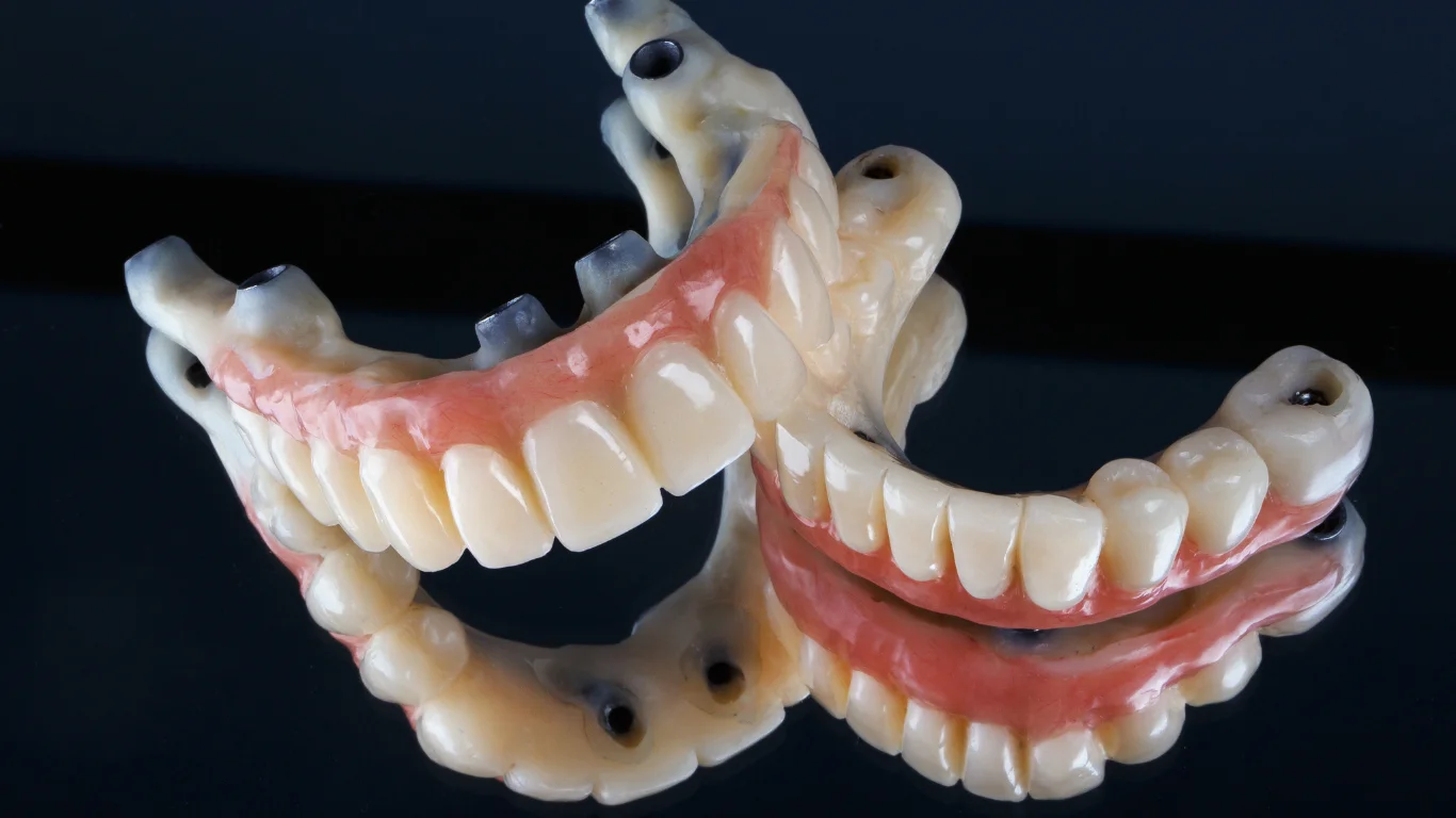 All on X Dental Implants