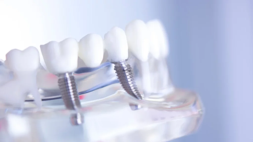 All on X Dental Implants