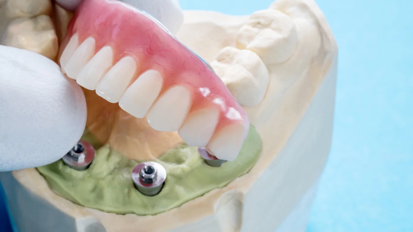 All on X Dental Implants