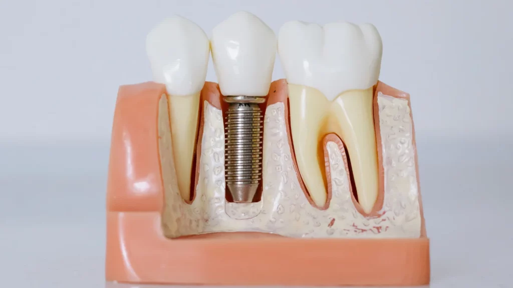 Implant Dentist