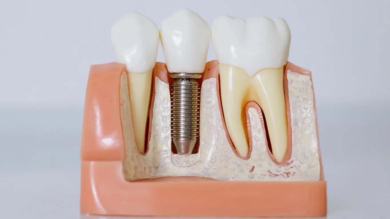 Implant Dentist