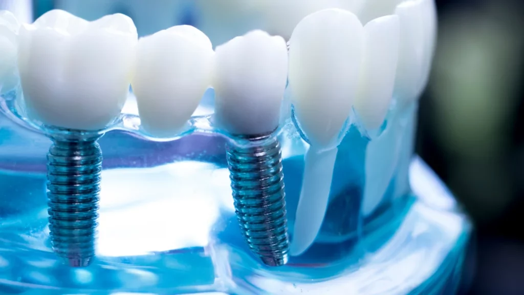 Implant Dentist