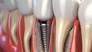Dental Implants