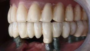 All on 6 Dental Implants