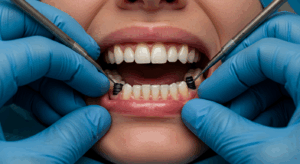 All on 4 dental implants