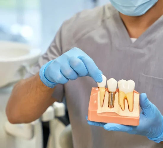 Dental Implants