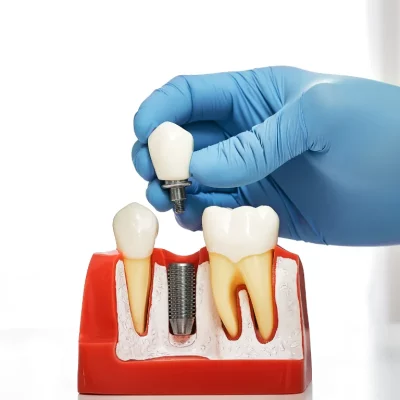 Dental Implants