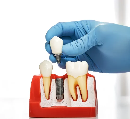 Dental Implants