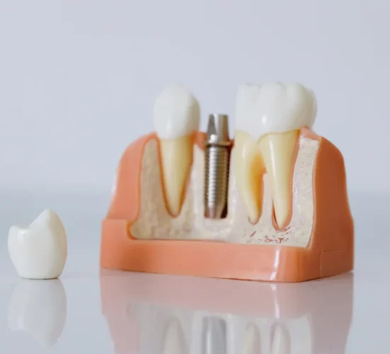 Dental Implants