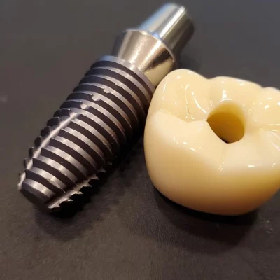 Dental Implants