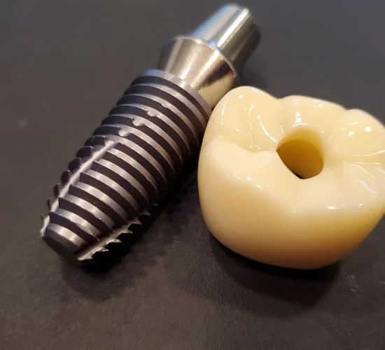 Dental Implants