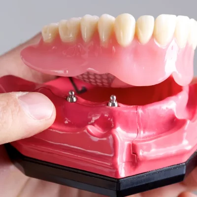 All on X Dental Implants