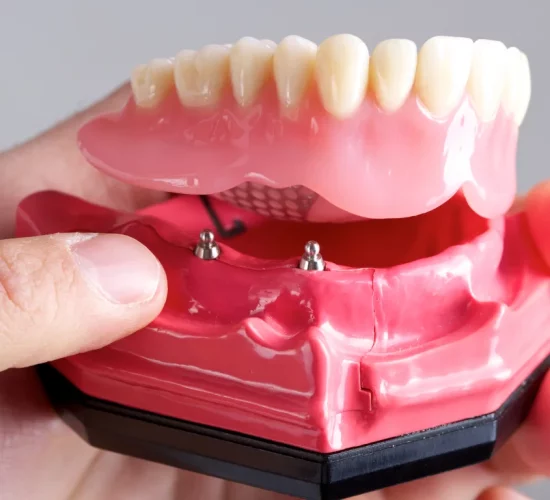 All on X Dental Implants