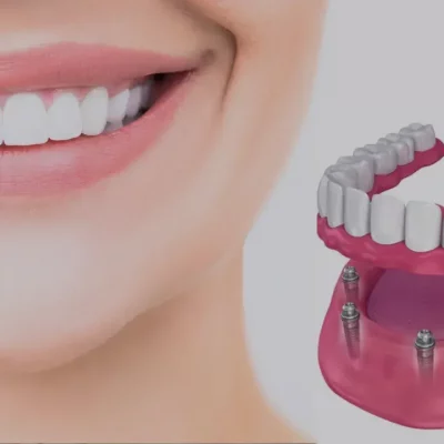 implant dentist